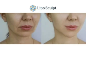 Explaining Total Skin Tightening Treatment And What It Can Do For You 2 Do you want to boost your self confidence? Give Morpheus8 Irthlingborough a try today!