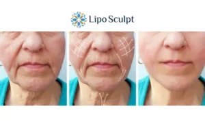 Explaining Total Skin Tightening Treatment And What It Can Do For You 3 Boost your confidence with Morpheus8 Irthlingborough call our team today!