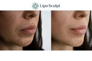 Explaining Total Skin Tightening Treatment And What It Can Do For You 4 Morpheus8 Irthlingborough the best results - call our team today!