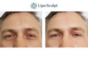 Explaining Total Skin Tightening Treatment And What It Can Do For You 6 Morpheus8 Irthlingborough book in today to find out more!