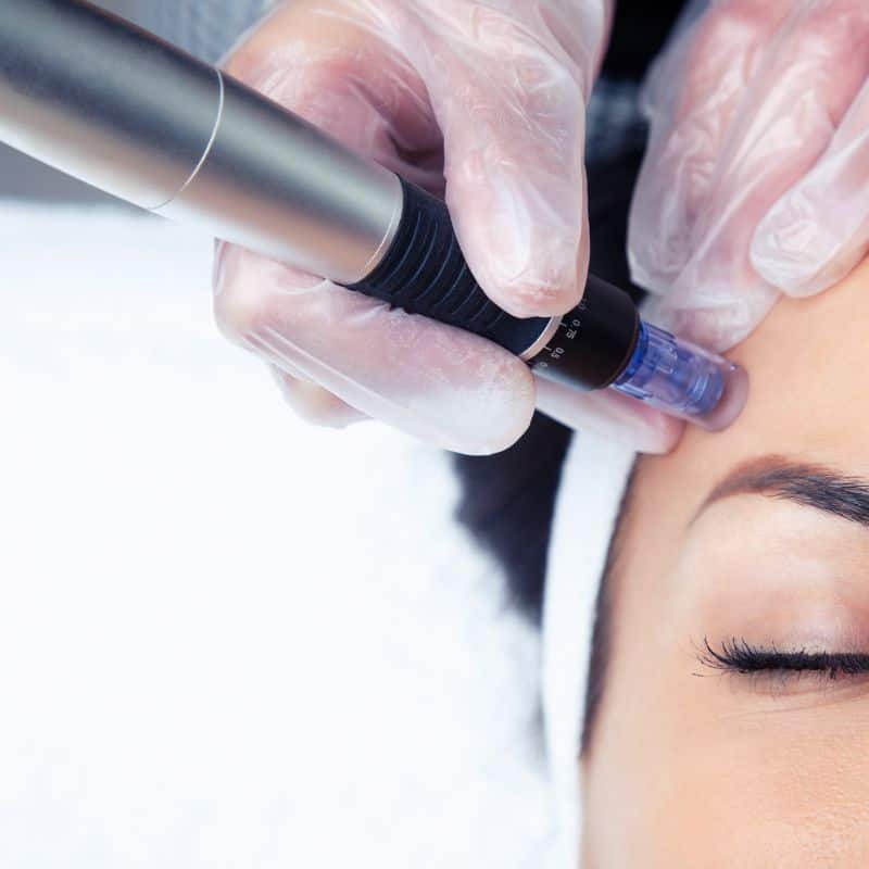 Morpheus8 treatment Irthlingborough from Lipo Sculpt - Book in today!
