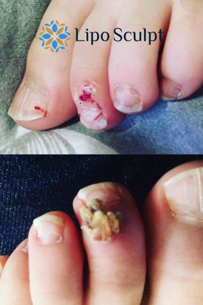 Wart removal customer results from Lipo Sculpt Irthlingborough