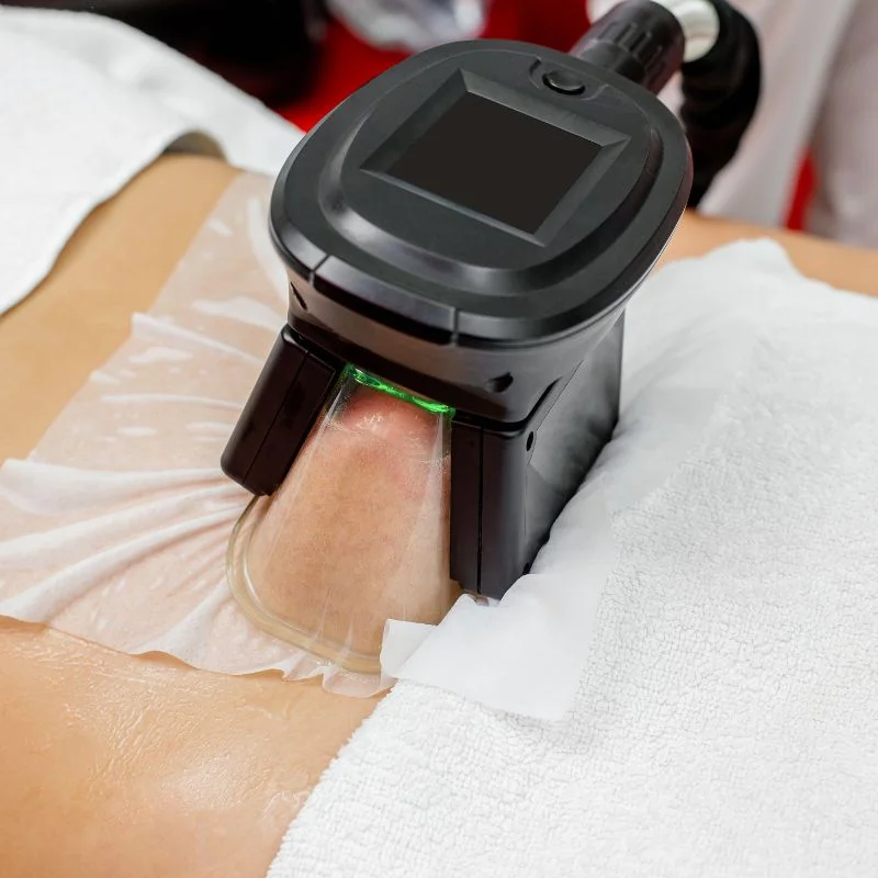 Fat Freezing treatment Irthlingborough